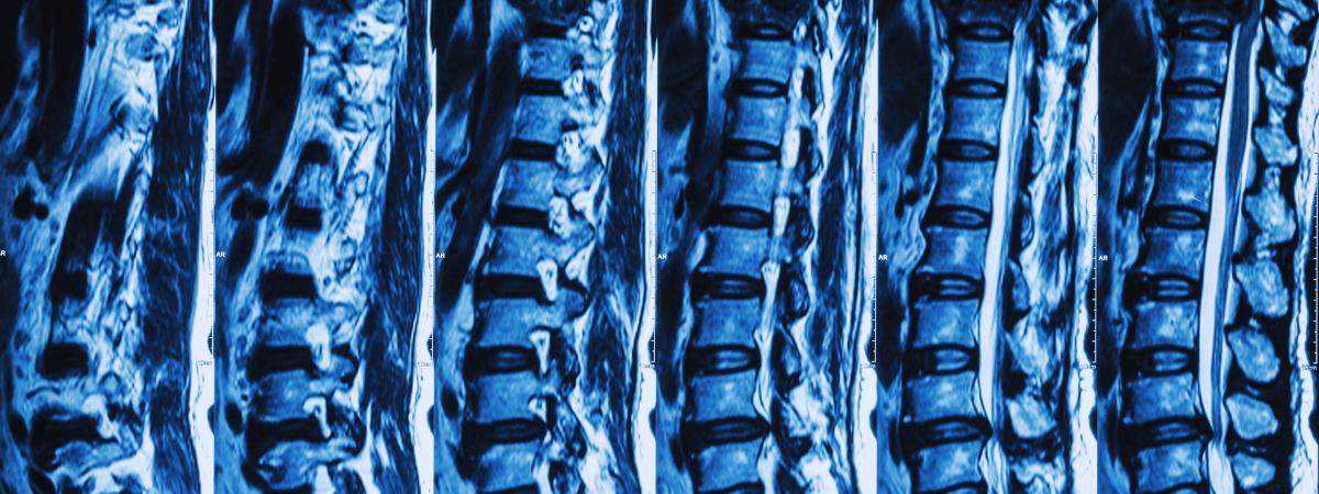Et si réduire les risques de fracture devenait plus simple ?