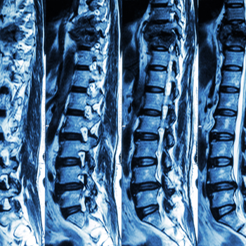 Et si réduire les risques de fracture devenait plus simple ?